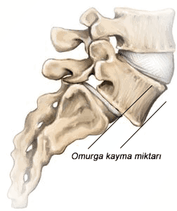 bel ağrısı disk kayması