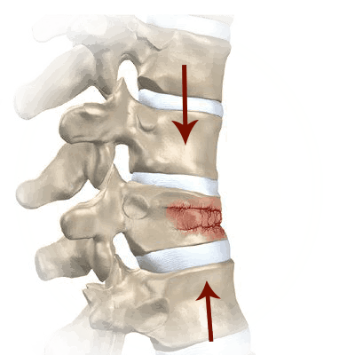 bel ağrısı omurga kırığı