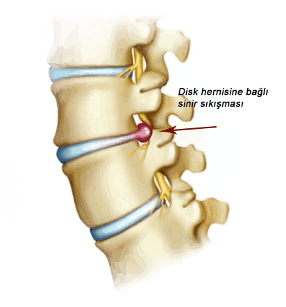bel ağrısı fıtık kayma