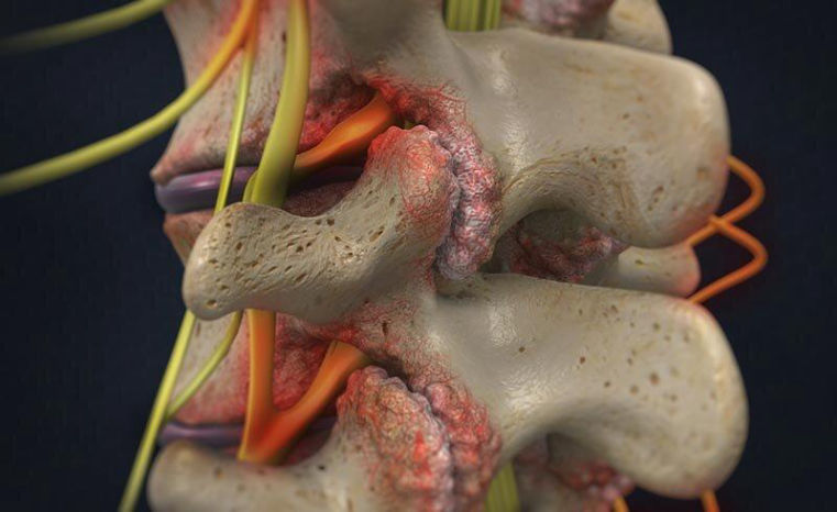 faset eklem dejenerasyon