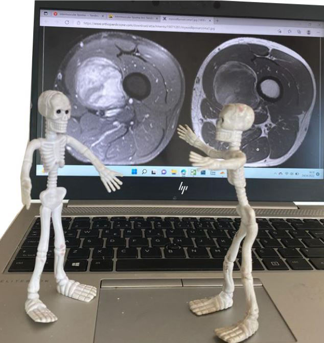 Yumuşak doku tümörleri